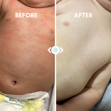 Load image into Gallery viewer, Eczema Relief Balm